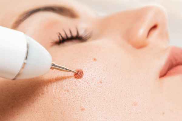 CryoPen: 5 Skin Concerns It May Be Used to Treat 3 What actually happens during a CryoPen treatment Littleport?